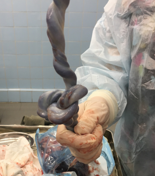 Nudo verdadero del cordón umbilical