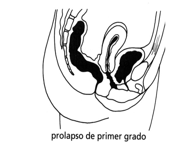 Prolapso primer grado
