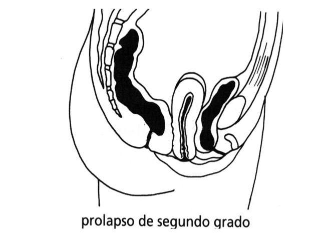 Prolapso segundo grado