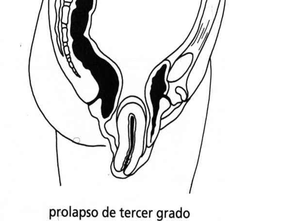 Prolapso tercer grado